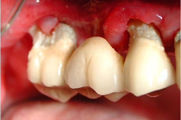 Periodontitt molarer