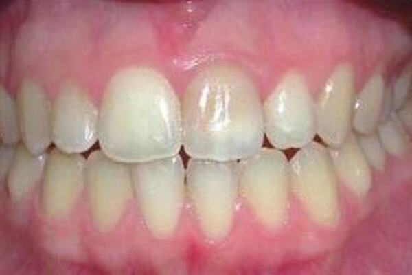 Bleking_tenner_web_V6_cropped_356x202