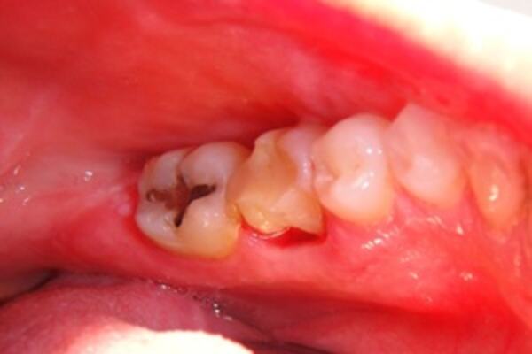 Frakturert_ og_rotfylt_36