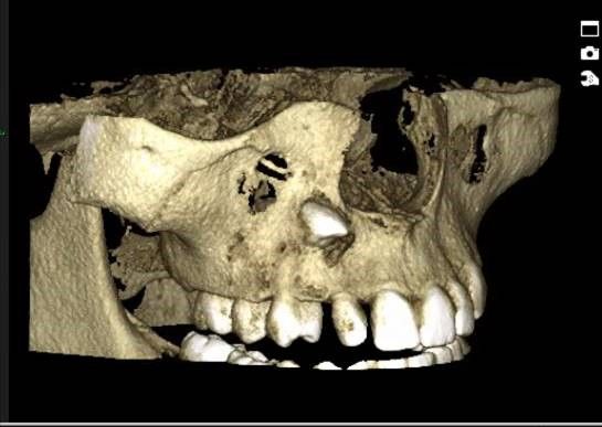 Tredimensjonalt bilde av ikke frembrudt tann