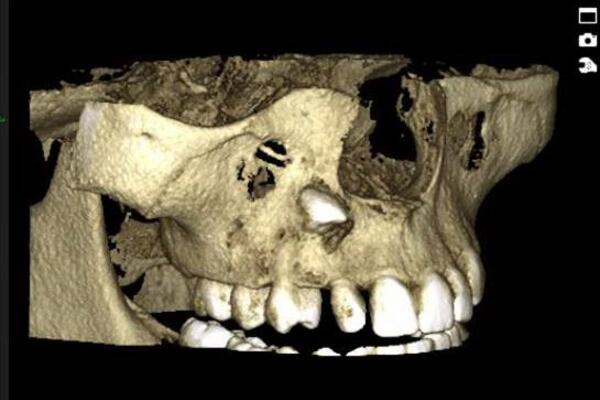 Tredimensjonalt bilde av ikke frembrudt tann