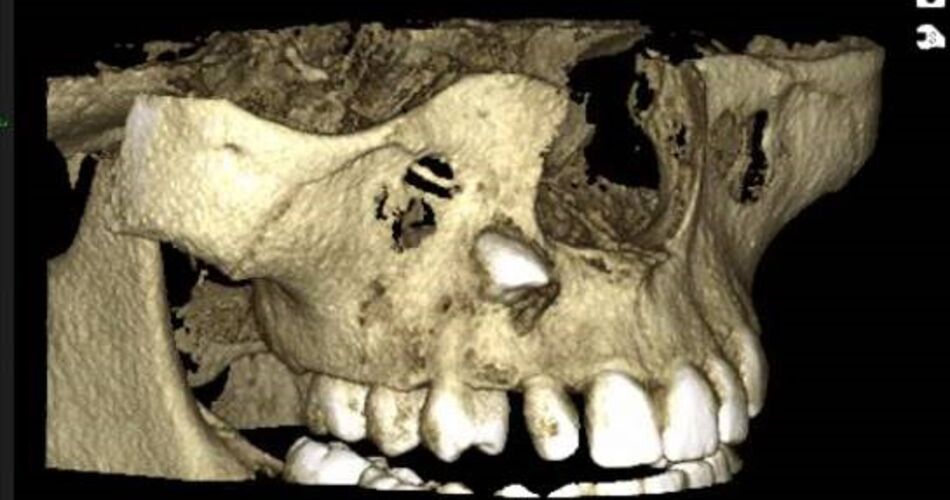 Tredimensjonalt bilde av ikke frembrudt tann
